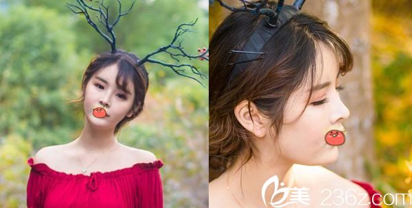 做完双眼皮和脂肪填充25天照片 做完双眼皮和脂肪填充25天照片