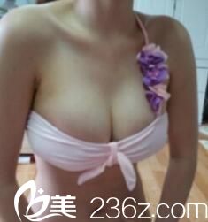 <!--<i data=20240703-sp></i>-->假体隆胸术后半个月