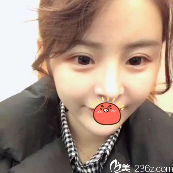 连天美做脂肪填充和双眼皮3个月后 连天美做脂肪填充和双眼皮3个月后