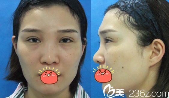 在宁波时光美极做隆鼻手术前 在宁波时光美极做隆鼻手术前