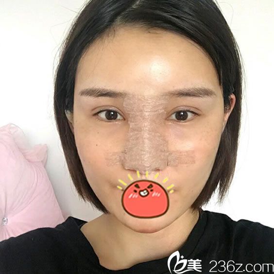 在宁波时光美极刚做完隆鼻和脂肪填充照片 在宁波时光美极刚做完隆鼻和脂肪填充照片