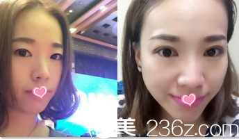 北京华韩双眼皮 北京华韩双眼皮