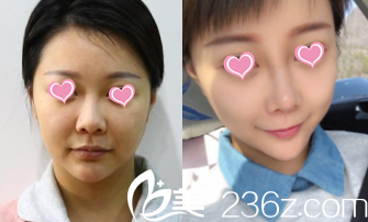 北京华韩假体隆鼻 北京华韩假体隆鼻