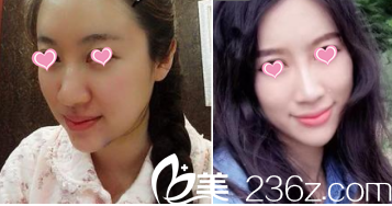 北京华韩面部吸脂 北京华韩面部吸脂