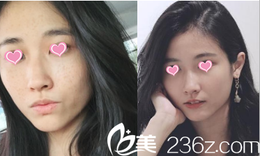 北京华韩去痘印 北京华韩去痘印