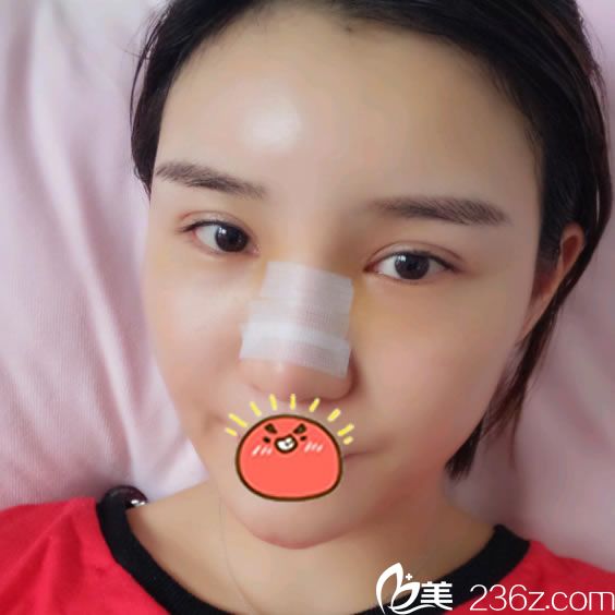 做完膨体耳软骨鼻综合和脂肪填充10天后 做完膨体耳软骨鼻综合和脂肪填充10天后