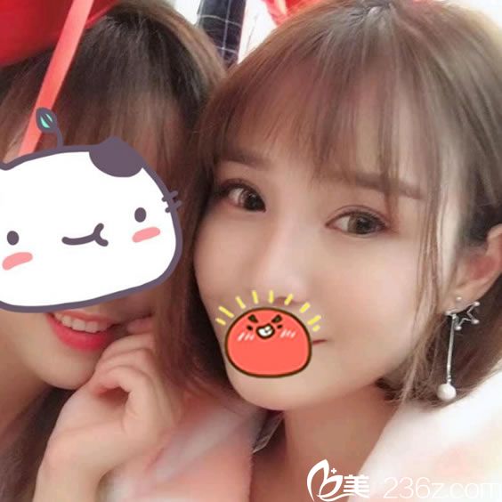 做完自体脂肪填充和隆鼻3个月照片 做完自体脂肪填充和隆鼻3个月照片