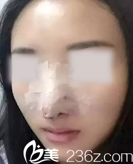 运城丽都杨顺新院长给我做鼻综合隆鼻术后第2天照片