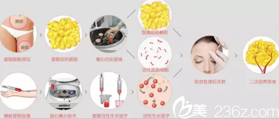 长春东方自体脂肪丰额头手术