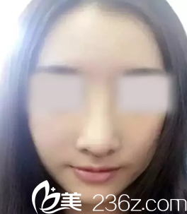 我早运城丽都杨顺新做鼻整形术后一周拆线的照片