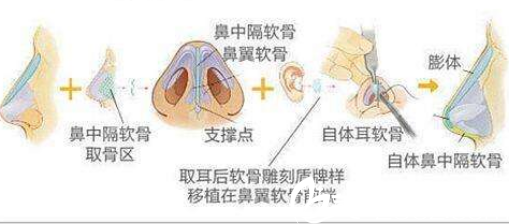 长春东方鼻综合手术过程