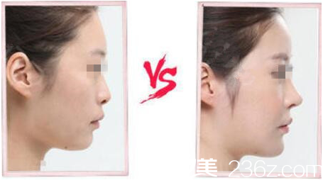 长春东方鼻综合手术案例