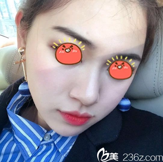 在时光美极做脂肪填充20天后