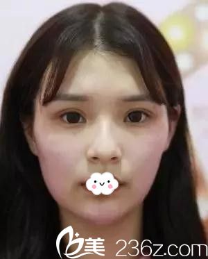 阜阳东方美莱坞线雕隆鼻真人案例 阜阳东方美莱坞线雕隆鼻真人案例