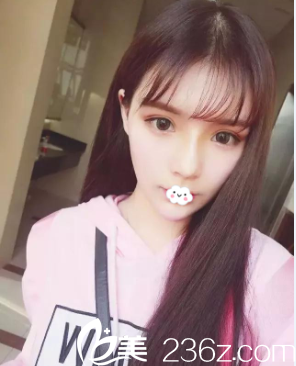 阜阳东方美莱坞线雕隆鼻术后效果怎么样 阜阳东方美莱坞线雕隆鼻术后效果怎么样