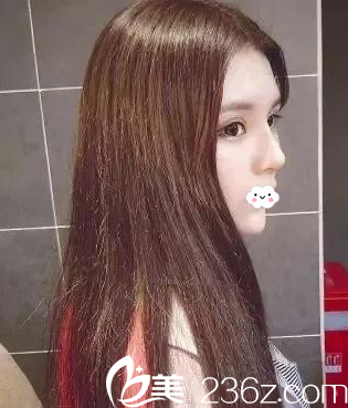 阜阳东方美莱坞线雕隆鼻术后恢复效果图 阜阳东方美莱坞线雕隆鼻术后恢复效果图