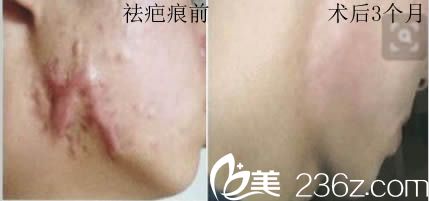 韩国安娜柯琳皮肤科李相浚激光祛疤前后对比图