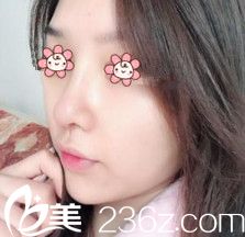 金顺珍鼻综合术后半个月