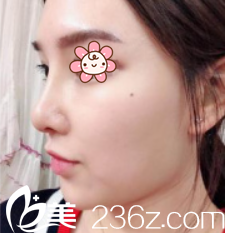 原来他们说韩国KSJ整形外科金顺珍做膨体隆鼻+鼻综合效果好不是空穴来风！