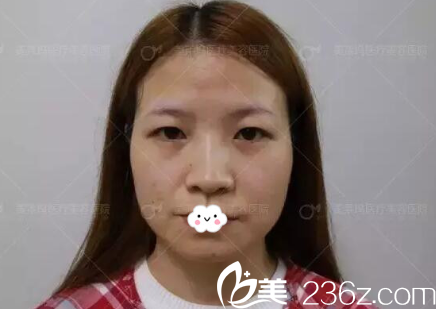 阜阳东方美莱坞高士乾切开双眼皮真人案例 阜阳东方美莱坞高士乾切开双眼皮真人案例