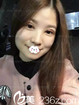 阜阳东方美莱坞双眼皮效果怎么样?高士乾真人案例 阜阳东方美莱坞双眼皮效果怎么样?高士乾真人案例