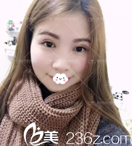 阜阳东方美莱坞双眼皮术后15天效果图 阜阳东方美莱坞双眼皮术后15天效果图