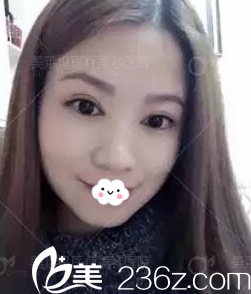 通过阜阳东方美莱坞高士乾切开双眼皮案例图了解阜阳做双眼皮哪家好？