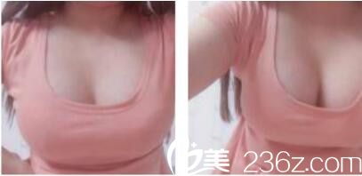 上海知音医院美容科张宾自体脂肪隆胸真人案例术后三个月