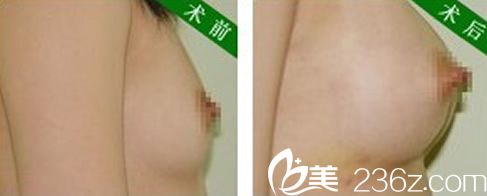 YNT整形外科医院林兑根医生隆胸手术案例 YNT整形外科医院林兑根医生隆胸手术案例