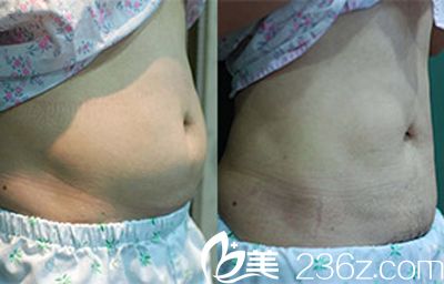 韩国德克莱斯（classic）整形医院腰腹吸脂案例对比图
