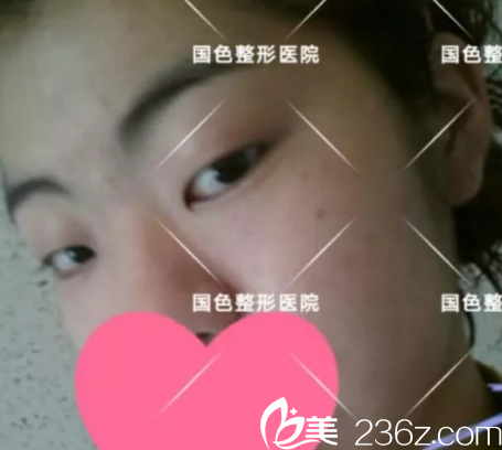 没有在蚌埠国色整形让程新德做双眼皮之前照片 没有在蚌埠国色整形让程新德做双眼皮之前照片