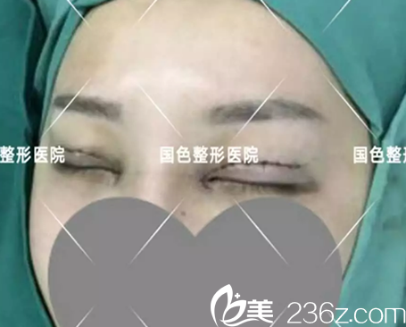 全切双眼皮+开内眼角术后即刻 全切双眼皮+开内眼角术后即刻