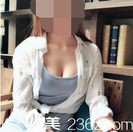 韩国PJS整形外科朴真奭自体脂肪丰胸术后三个月 韩国PJS整形外科朴真奭自体脂肪丰胸术后三个月