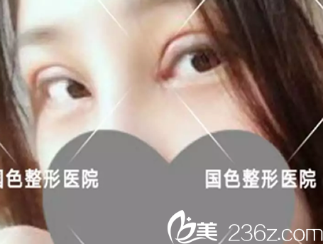 程新德割双眼皮开眼角术后第3天恢复情况 程新德割双眼皮开眼角术后第3天恢复情况