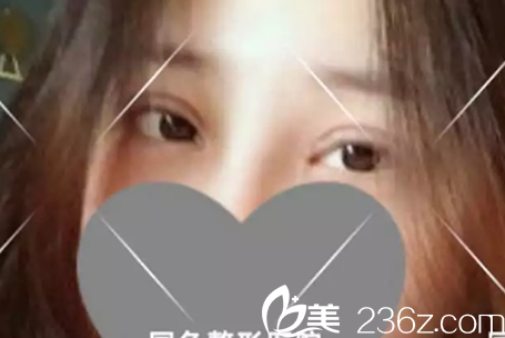 蚌埠国色整形全切双眼皮加开内眼角术后第7天图 蚌埠国色整形全切双眼皮加开内眼角术后第7天图