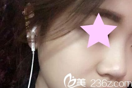 韩国YNT整形医院硅胶隆鼻手术前 韩国YNT整形医院硅胶隆鼻手术前