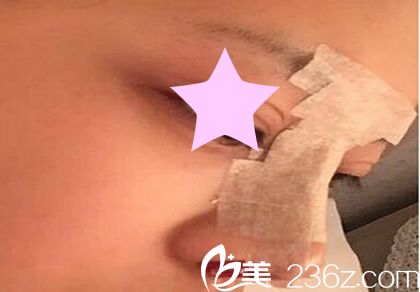 尹炯老医生隆鼻手术第2天 尹炯老医生隆鼻手术第2天