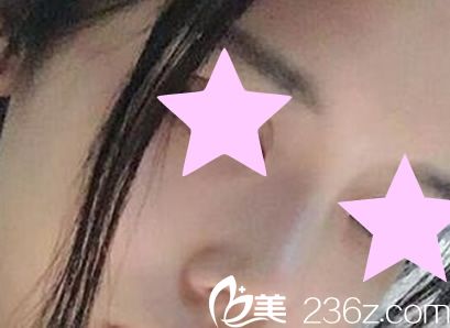 硅胶隆鼻7天后恢复效果图 硅胶隆鼻7天后恢复效果图