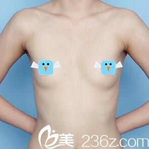 假体隆胸术前照 假体隆胸术前照