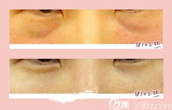 徐元德医生激光去黑眼圈案例