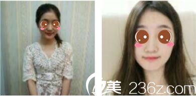 韩国休&美整形外科徐义锡假体隆鼻真人案例术前照 韩国休&美整形外科徐义锡假体隆鼻真人案例术前照