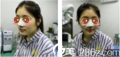 韩国休&美整形外科徐义锡假体隆鼻真人案例术后第三天