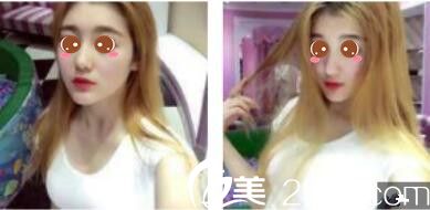 韩国休&美整形外科徐义锡假体隆鼻真人案例术后第七天 韩国休&美整形外科徐义锡假体隆鼻真人案例术后第七天