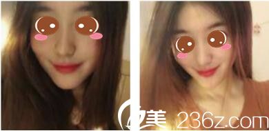 韩国休&美整形外科徐义锡假体隆鼻真人案例术后一个月 韩国休&美整形外科徐义锡假体隆鼻真人案例术后一个月