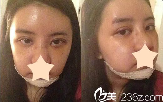 韩国安娜柯琳皮肤科面部轮廓+双眼皮术后1个月照