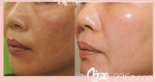 金敏英激光去除黄褐斑案例分享