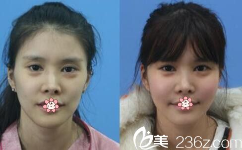 张琼浩自体脂肪面部填充案例 张琼浩自体脂肪面部填充案例