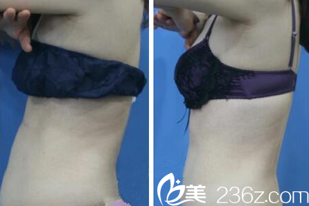 林洪哲院长腰腹部吸脂案例