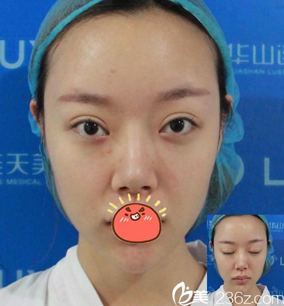 在杭州连天美做双眼皮修复前 在杭州连天美做双眼皮修复前