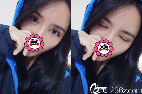 术后15天效果 术后15天效果